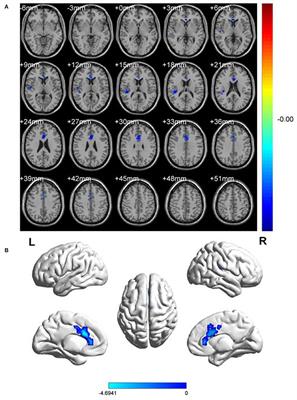 Detection of Abnormal Spontaneous Brain Activity Patterns in Patients With Orbital Fractures Using Fractional Amplitude of Low Frequency Fluctuation